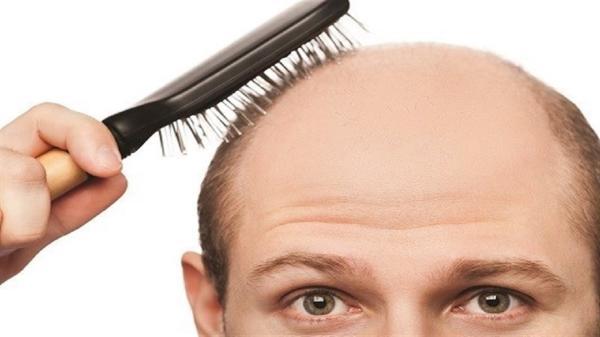 درمان خانگی ریزش مو با 4 روغن